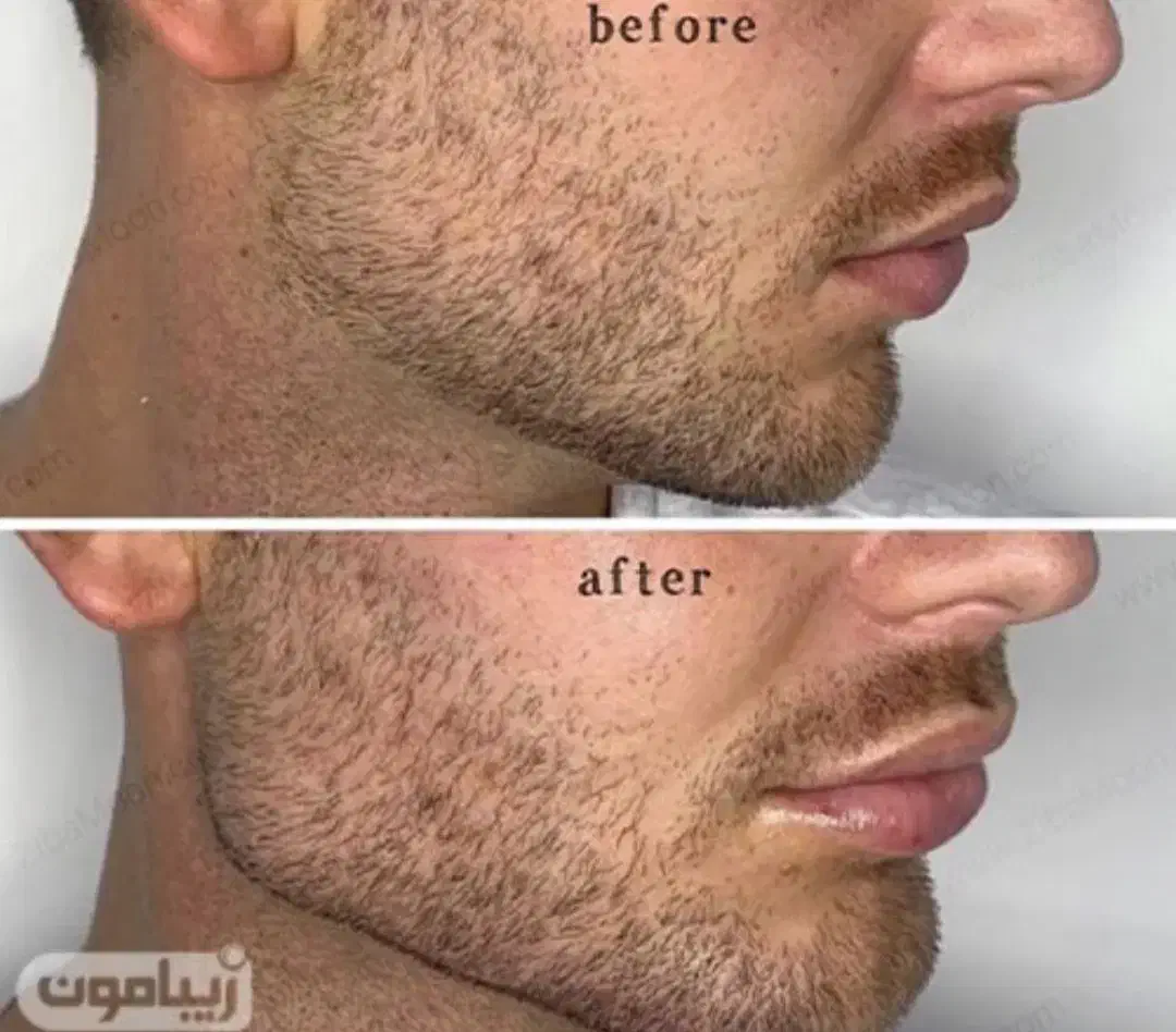 جشنواره ی پاییزه ژل ،بوتاکس،مزو|خدمات آرایشگری و زیبایی|شاهین‌شهر, فردوسی|دیوار