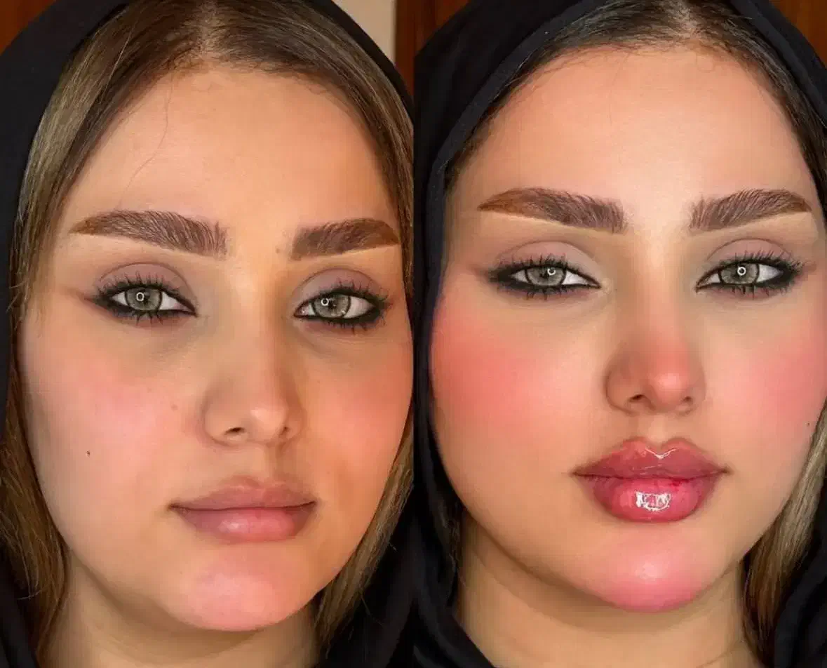 تخفیف خدمات ژل/بوتاکس/جوانساز توسط پزشک|خدمات زیبایی و سلامت|اهواز, زیتون کارمندی|دیوار