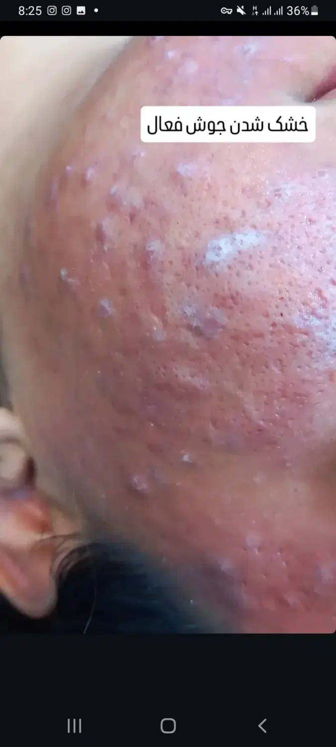 فیشال و پاکسازی صورت در کلینیک|خدمات آرایشگری و زیبایی|شهرکرد, |دیوار