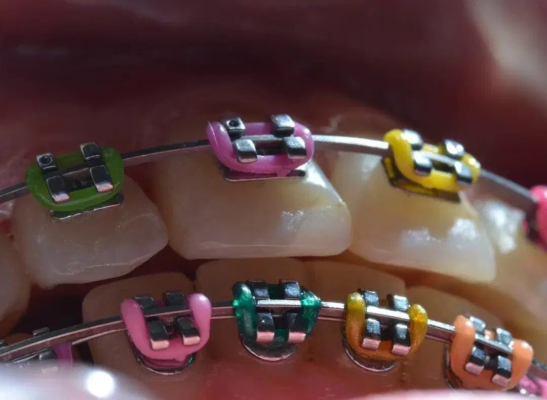 ارتودنسی ثابت و متحرک با اقساط بلند مدت|خدمات آرایشگری و زیبایی|آذرشهر, |دیوار