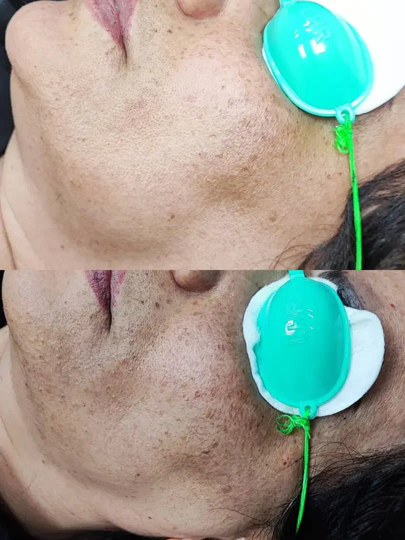 ریموو تتو و رفع تیرگی بدن در مطب پزشک|خدمات آرایشگری و زیبایی|آبادان, |دیوار