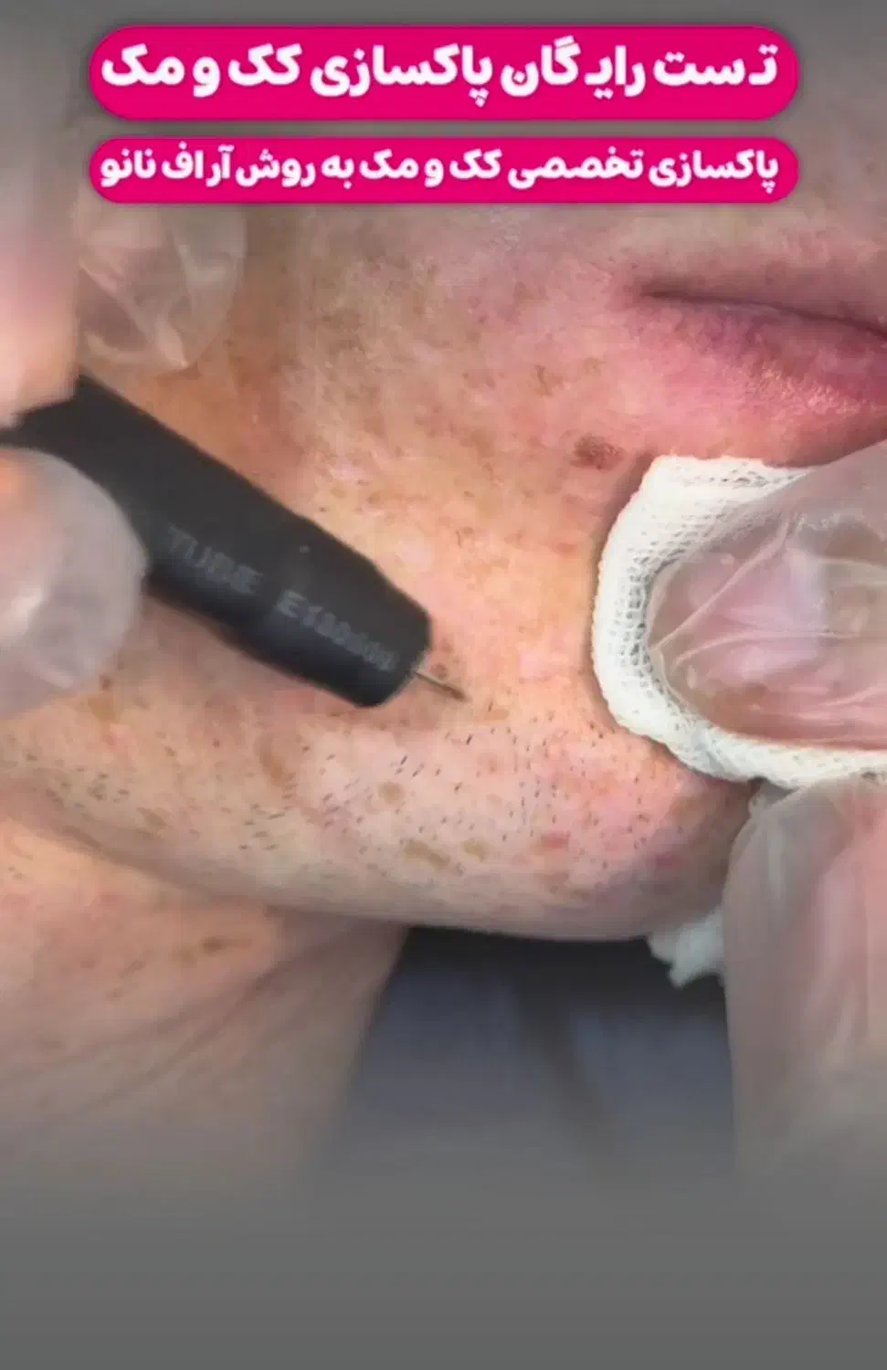 مرکز تخصصی حذف لک وکک ومک|خدمات آرایشگری و زیبایی|اهواز, پادادشهر|دیوار