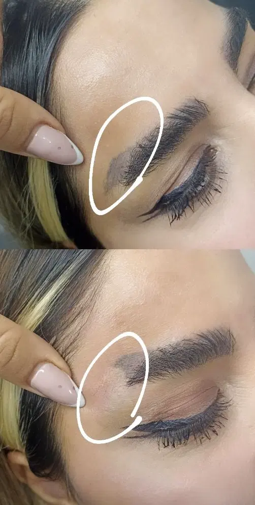 تخفیفات پاککردن تتو صورت وبدن|خدمات زیبایی و سلامت|کرمانشاه, |دیوار