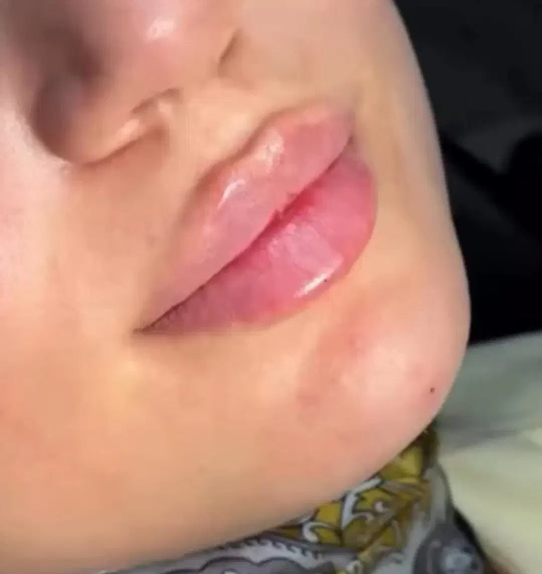 نیازمند مدل تزریق ژل|خدمات آرایشگری و زیبایی|ارومیه, |دیوار