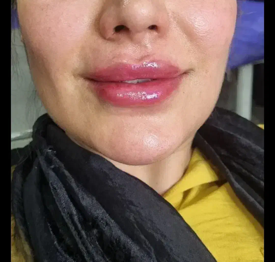 تزریق ژل وبوتاکس و آموزش فیلر با 5سال سابقه کاری|خدمات آرایشگری و زیبایی|جیرفت, |دیوار