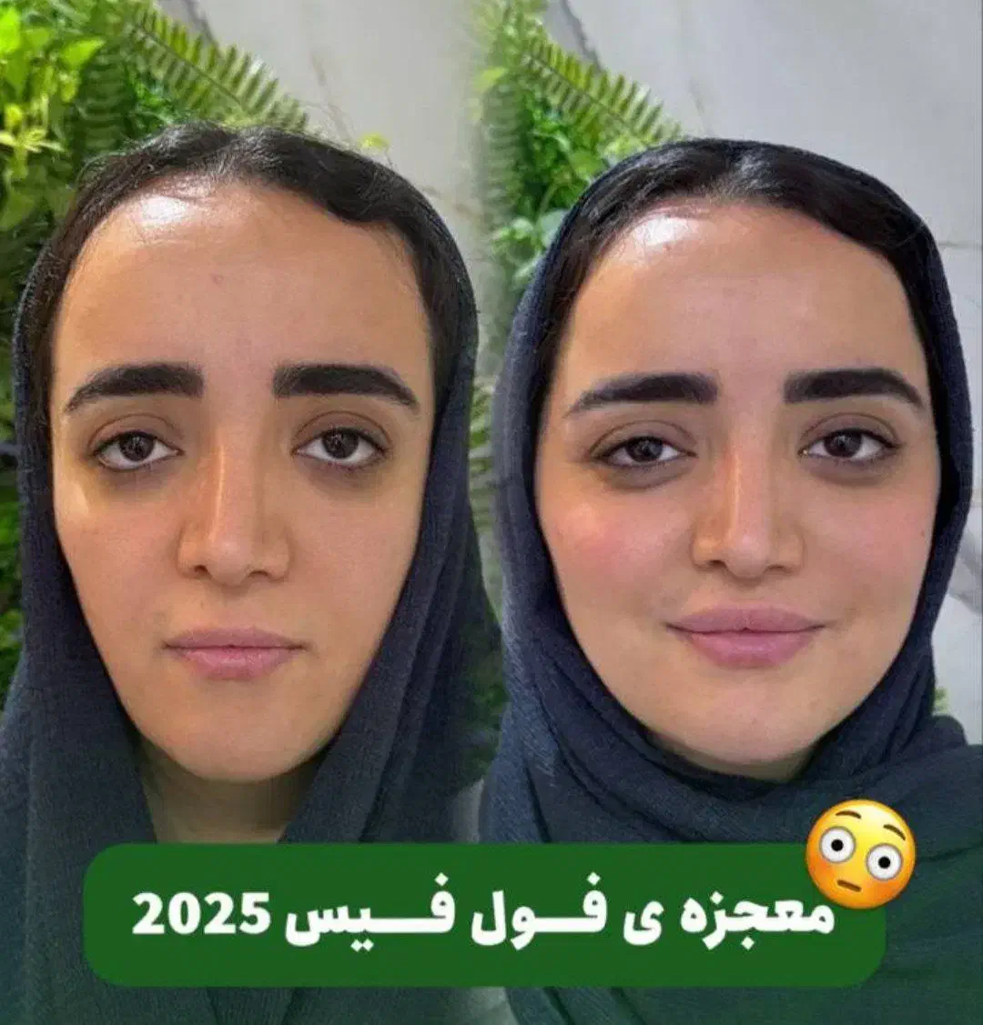 جشنواره تزریق ژل و لیفت صورت|خدمات آرایشگری و زیبایی|قم, زنبیل آباد|دیوار