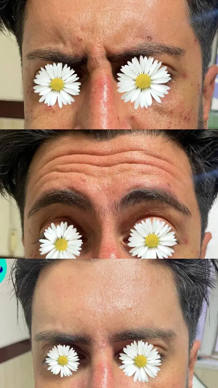 بوتاکس/پی آر پی/ژل لب/لیزر /مسکن|خدمات آرایشگری و زیبایی|کرمانشاه, |دیوار