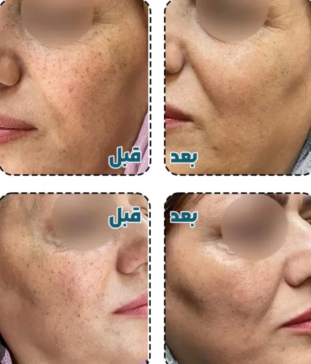 درمان لک|خدمات آرایشگری و زیبایی|مشهد, فردوسی|دیوار