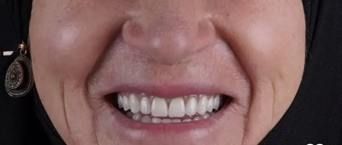 دندانسازی دندان مصنوعی|خدمات آرایشگری و زیبایی|مشهد, هفت تیر (آب و برق)|دیوار