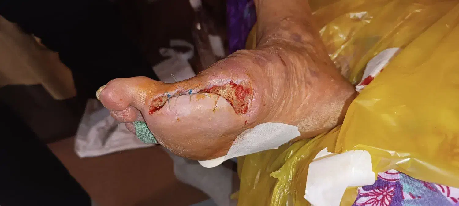 پانسمان نوین زخم بستر / دیابتی / سوختگی / سرطانی|خدمات آرایشگری و زیبایی|ارومیه, |دیوار