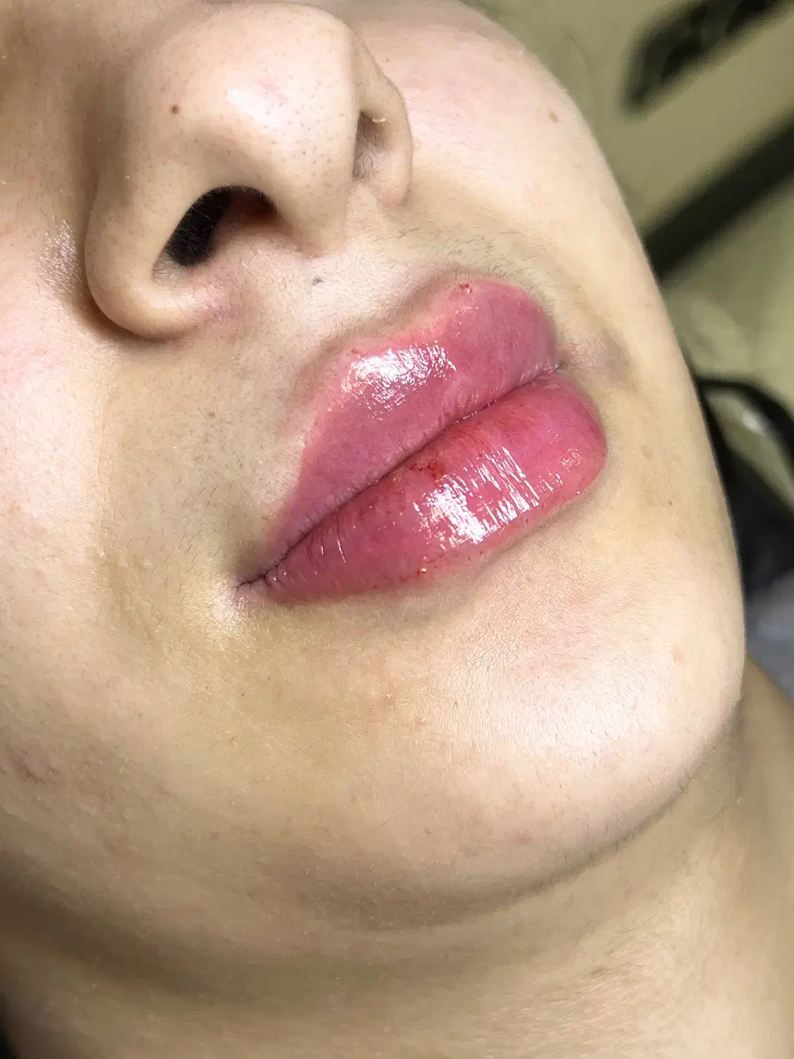 تزریق ژل و بوتاکس در کلینیک|خدمات آرایشگری و زیبایی|نسیم‌شهر, |دیوار