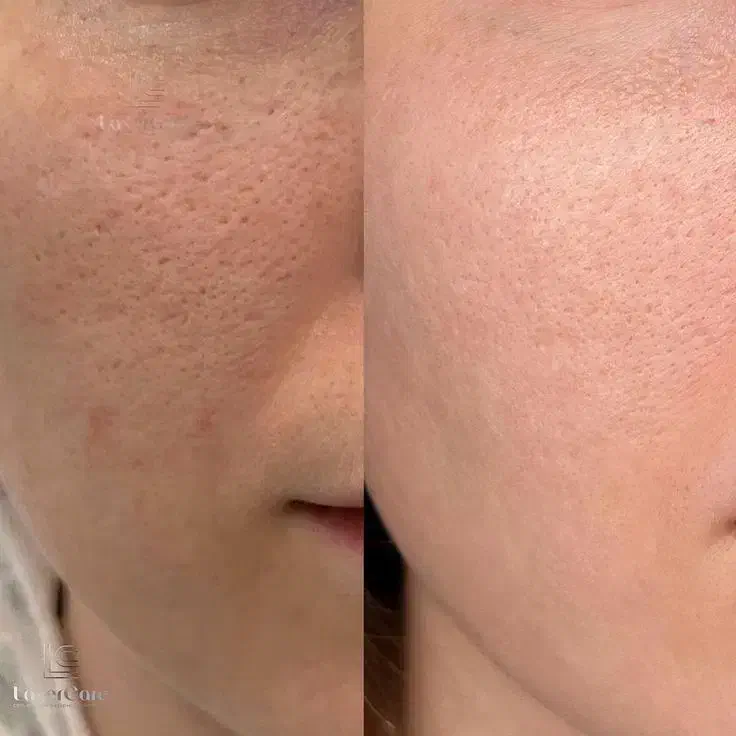 پاکسازی پوست، فیشال و ماسک تخصصی|خدمات آرایشگری و زیبایی|رشت, گلسار|دیوار