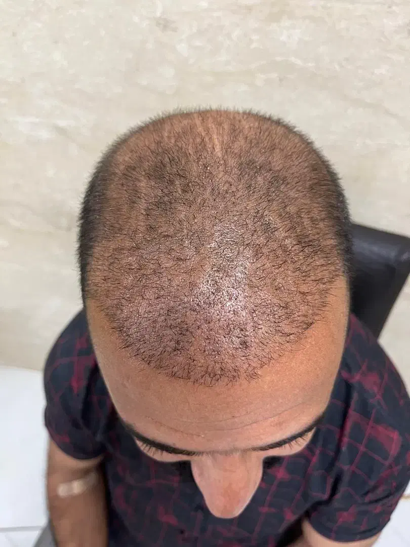 کاشت مو 12 ملیون با ضمانت|خدمات آرایشگری و زیبایی|تبریز, |دیوار