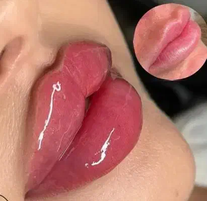 تخفیفات پاییزه   ژل ، بوتاکس ، فیلر،جوانسازی پوست|خدمات آرایشگری و زیبایی|تهران, نیروی هوایی (پیروزی)|دیوار