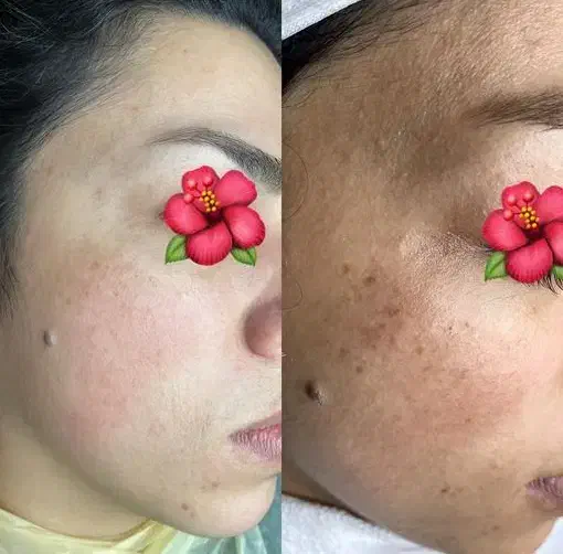 درمان و رفع تیرگی پوستی و لک|خدمات آرایشگری و زیبایی|مشهد, احمدآباد|دیوار