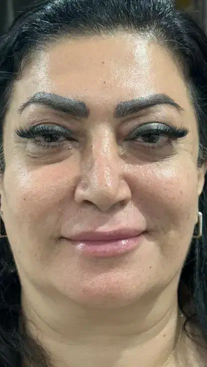 جشنواره اندولیفت تخصصی صورت وگردن|خدمات آرایشگری و زیبایی|تهران, جماران (نیاوران)|دیوار