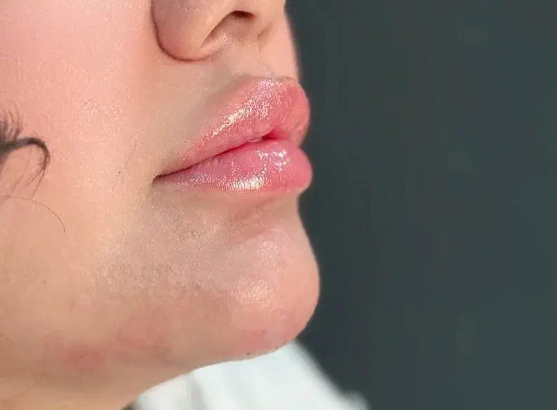 تزریق فیلر نورامیس صورت لب|خدمات آرایشگری و زیبایی|تهران, تهرانسر مرکزی|دیوار