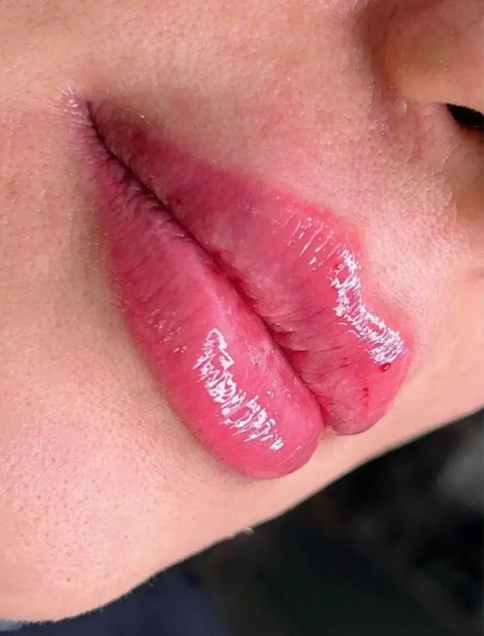 تزریق ژل لب وکانتورینگ(+بوتاکس رایگان|خدمات آرایشگری و زیبایی|کرمانشاه, |دیوار