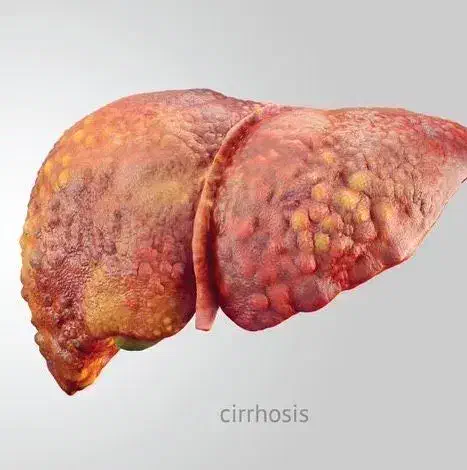 التهاب کبد|آرایشی، بهداشتی، درمانی|اردبیل, |دیوار