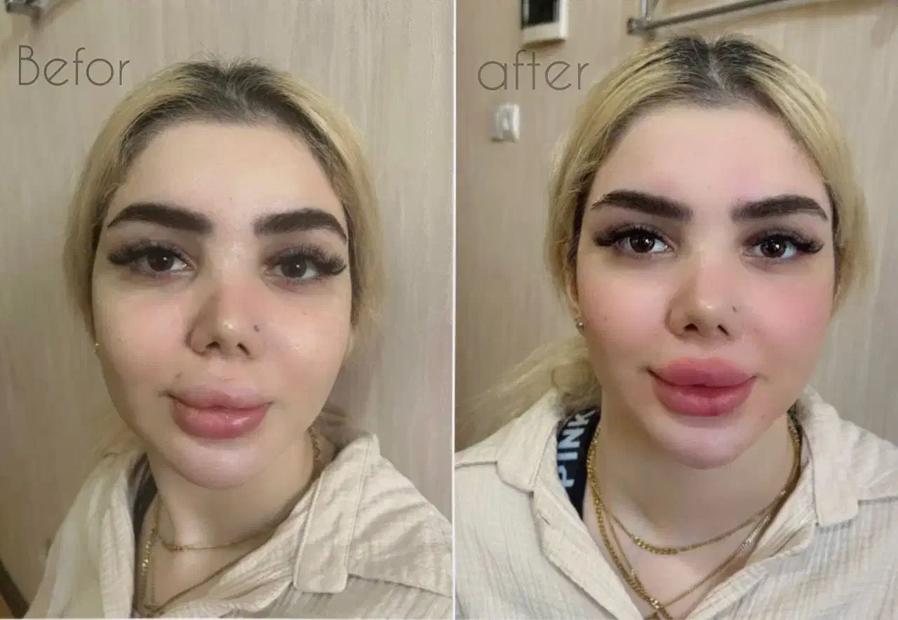 ژل بوتاکس کانتورینگ صورت آنزیم فیلر بینی مزوژل|خدمات آرایشگری و زیبایی|گرمسار, |دیوار