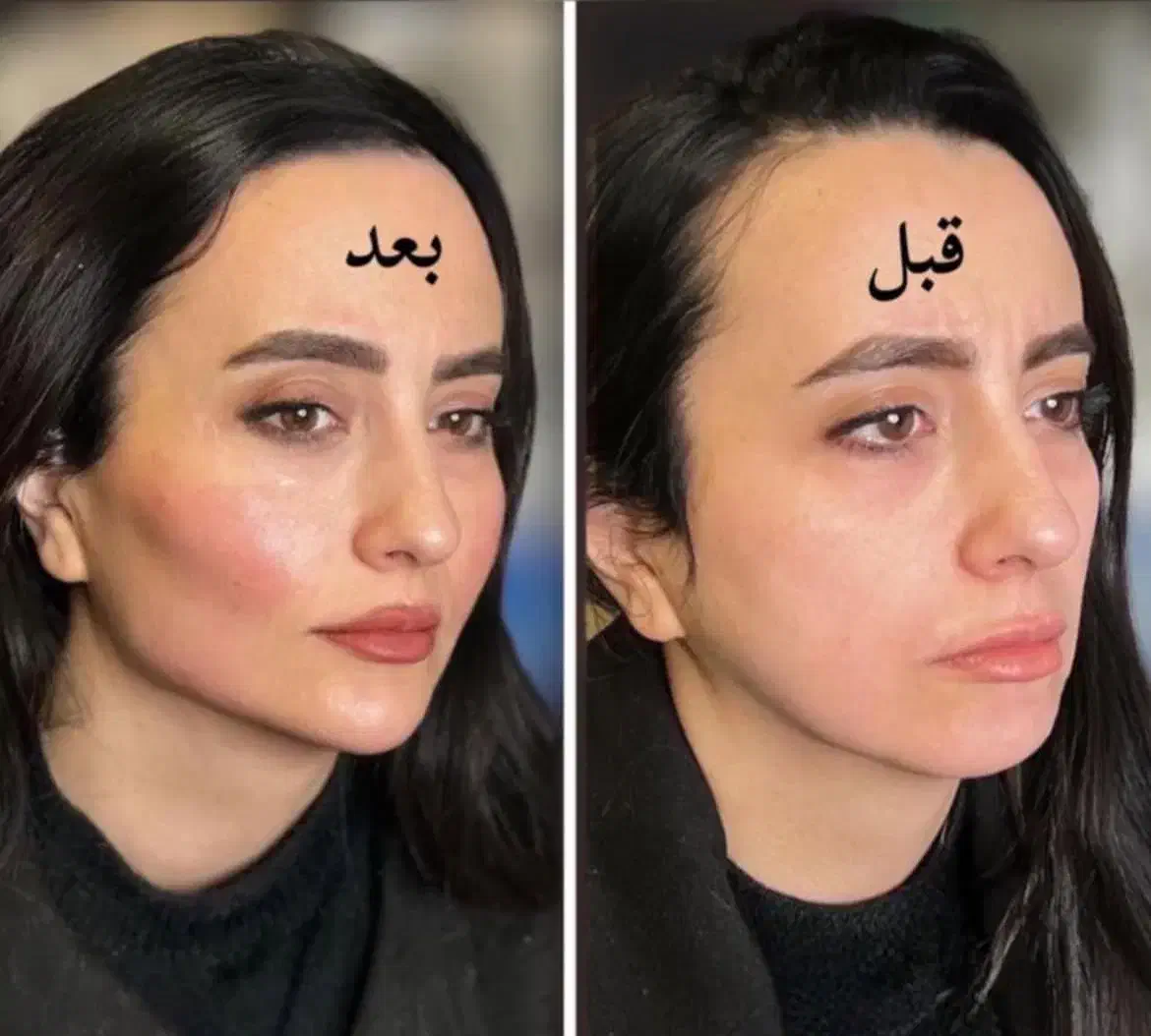 فیلر لب بوتاکس مادلینگ زیرچشم فیلر باسن بیکینی نخ|خدمات آرایشگری و زیبایی|تهران, پاسداران|دیوار