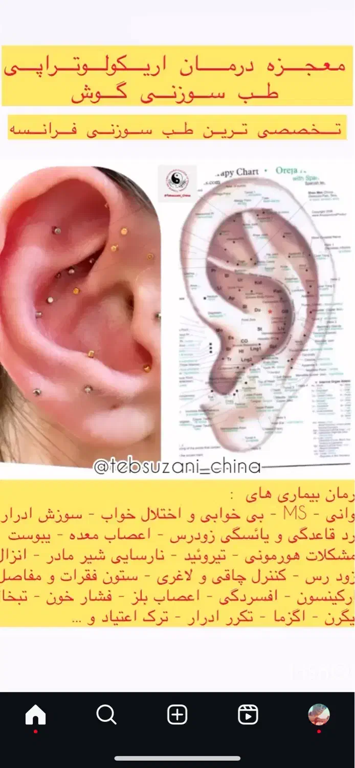 درمان تضمینی بیماری ها با طب سوزنی گوش ای اس پی|خدمات آرایشگری و زیبایی|کرمان, |دیوار