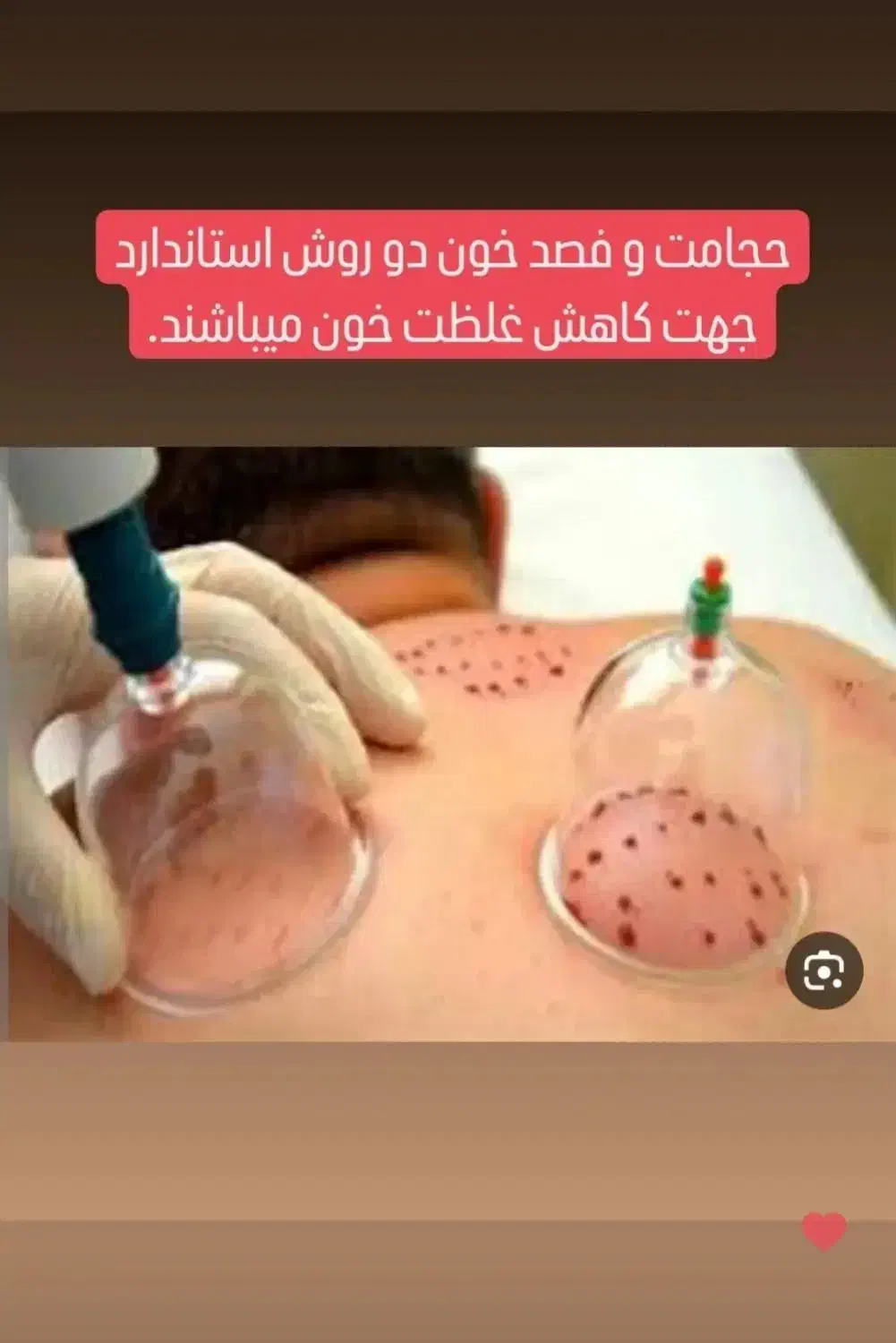 حجامت، فصد خون، تزریقات، بخیه|خدمات آرایشگری و زیبایی|اهر, |دیوار