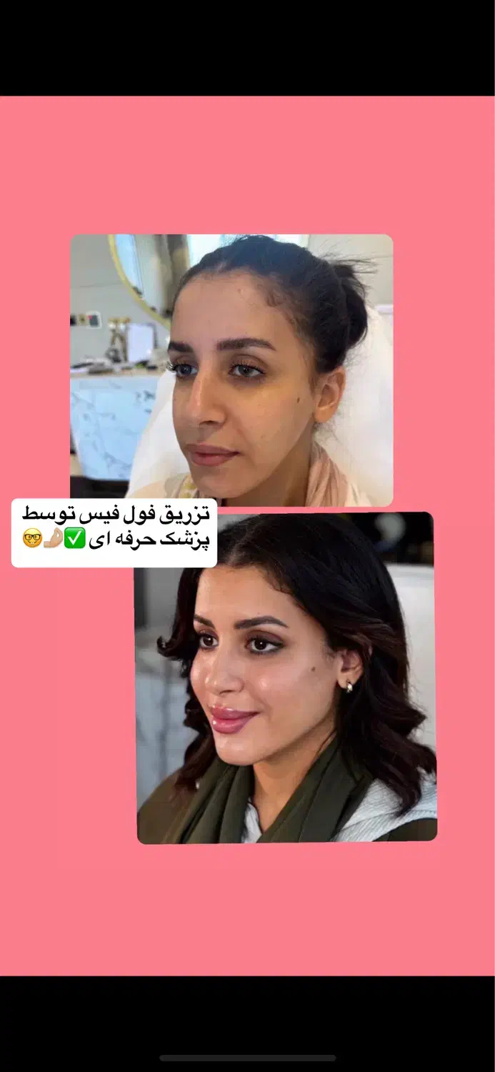 تخفیفات طلایی/ژل لب/ بوتاکس/ گونه/ فول فیس خط خنده|خدمات آرایشگری و زیبایی|مشهد, دانشجو|دیوار