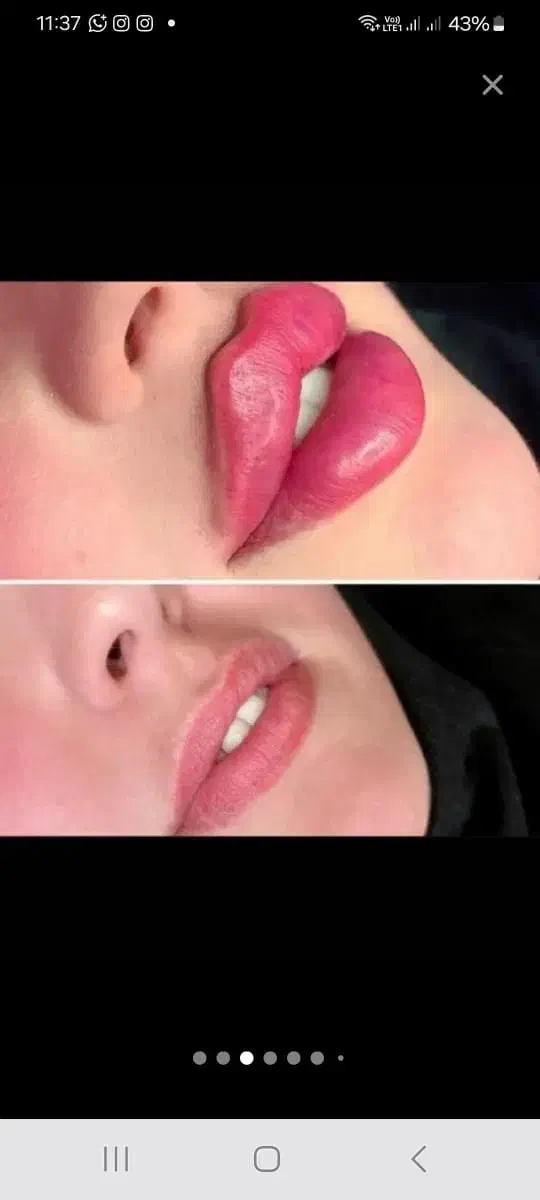 جشنواره لیزر مو تزریق ژل لب بوتاکس فیلر لیفت صورت|خدمات آرایشگری و زیبایی|تهران, ستارخان|دیوار