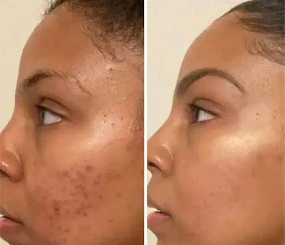 پاکسازی صورت فقط ۲۵۰|خدمات آرایشگری و زیبایی|زرند, |دیوار