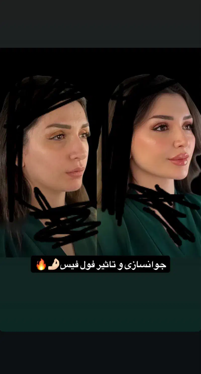 تخفیفات جمعه سیاه با بوتاکس رایگان توسط پزشک|خدمات آرایشگری و زیبایی|قم, هفت تیر|دیوار