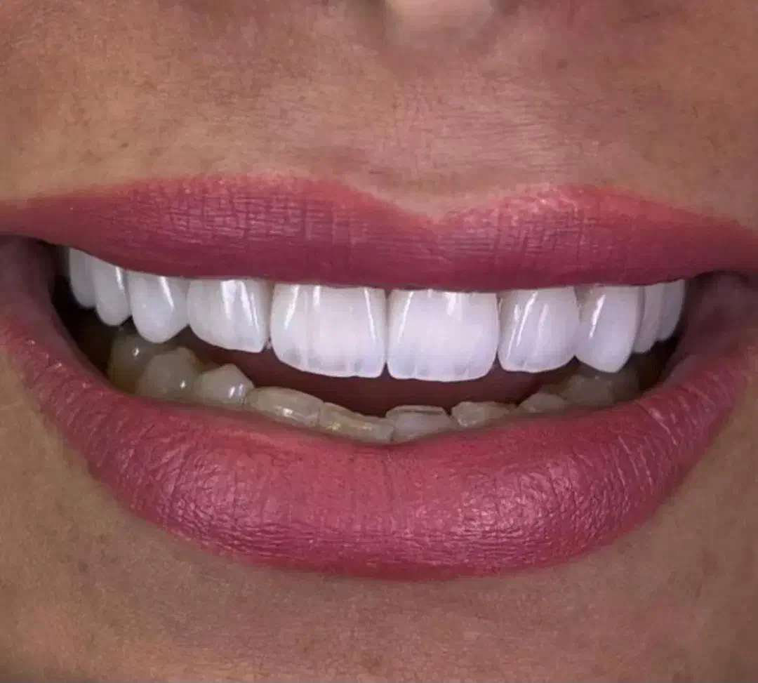 خدمات زیبایی کامپوزیت لمینیت بلیچینگ|خدمات آرایشگری و زیبایی|قم, زنبیل آباد|دیوار