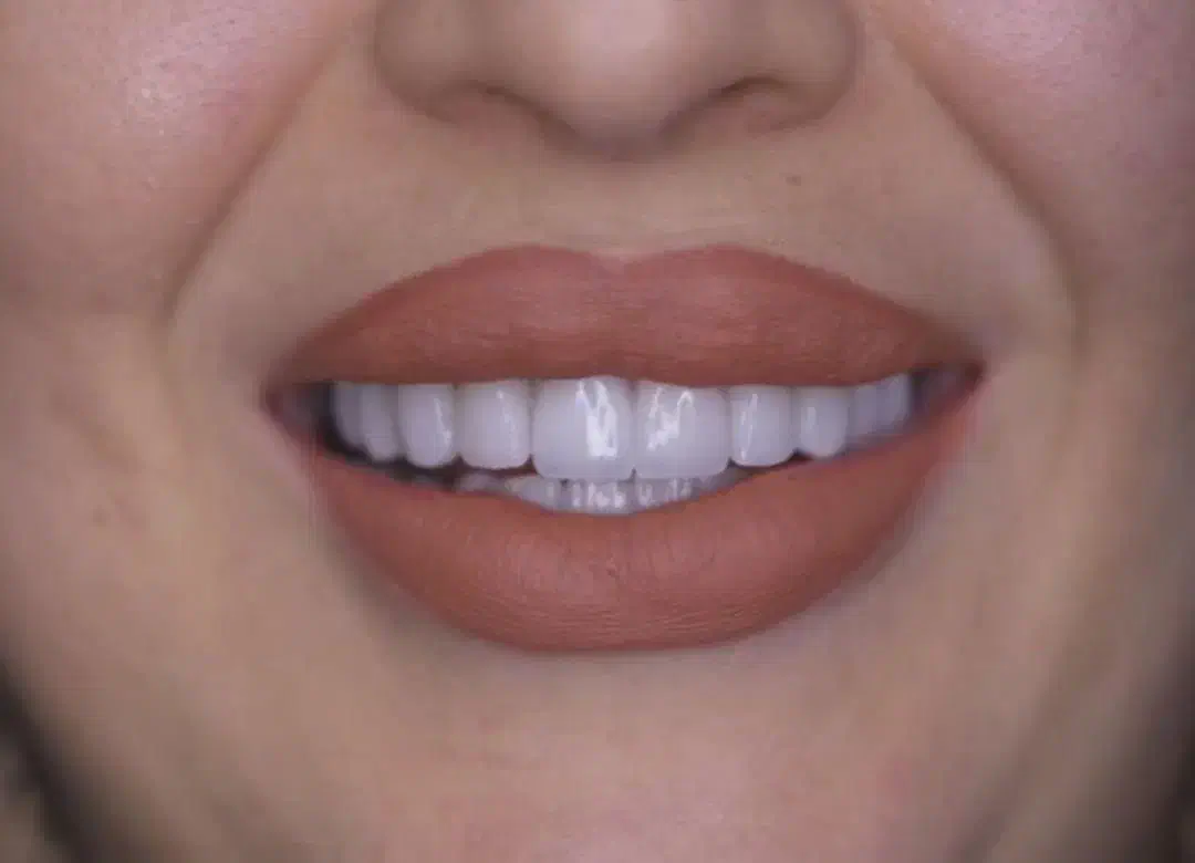 کامپوزیت دندان کامپوزیت زیبایی ونیر|خدمات آرایشگری و زیبایی|قم, چهار امامزاده|دیوار