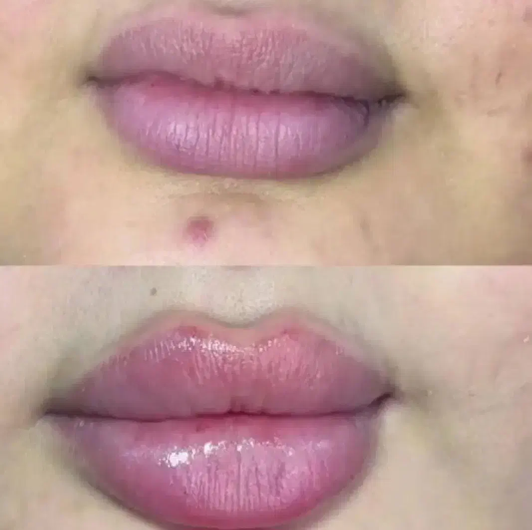 فیلر لب|خدمات آرایشگری و زیبایی|کاشان, امیرکبیر|دیوار