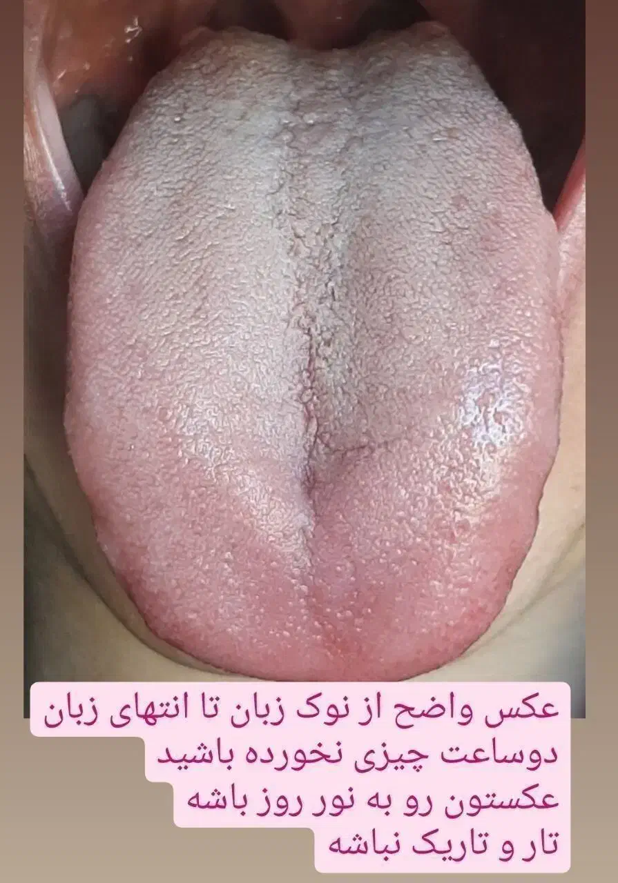 تشخیص بیماری ها فقط از روی عکس زبان بصورت ناشتا|خدمات آرایشگری و زیبایی|زابل, |دیوار
