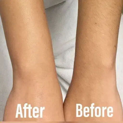 لیزر خانگی موهای زائد صورت و بدن/تخفیف بلک فرایدی|آرایشی، بهداشتی، درمانی|قم, زنبیل آباد|دیوار