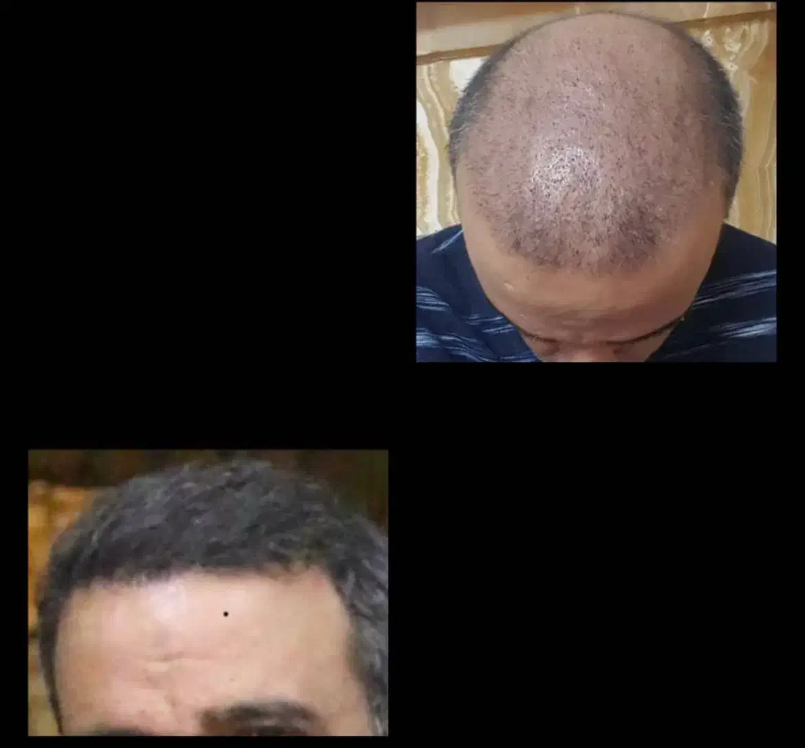 کاشت مو/کاشت ابرو/کاشت ریش/بالاترین تراکم/تضمینی|خدمات آرایشگری و زیبایی|مشهد, سجاد شهر|دیوار