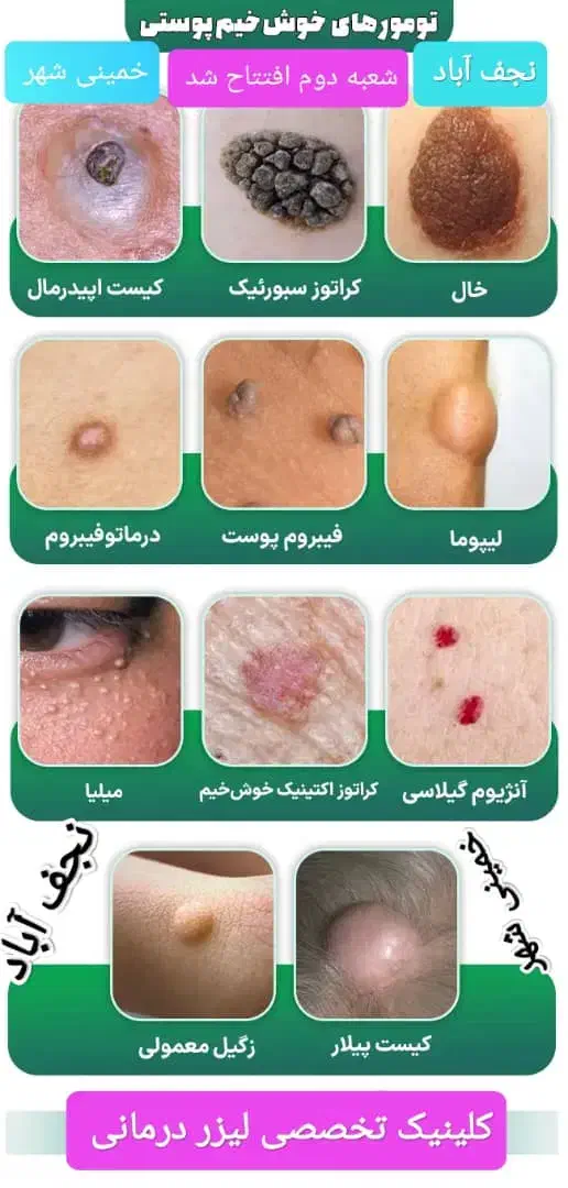 لیزرمو خانم300آقا600ریموتتوخال ژل بوتاکس لک پوستی|خدمات آرایشگری و زیبایی|نجف‌آباد, ویلاشهر|دیوار