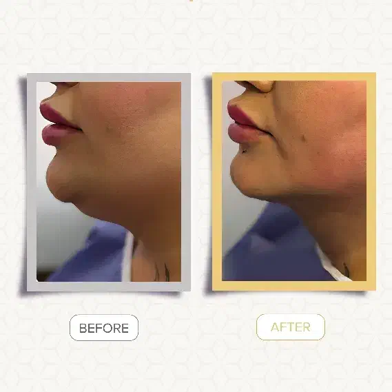 ساکشن غبغب|خدمات آرایشگری و زیبایی|رشت, گلسار|دیوار