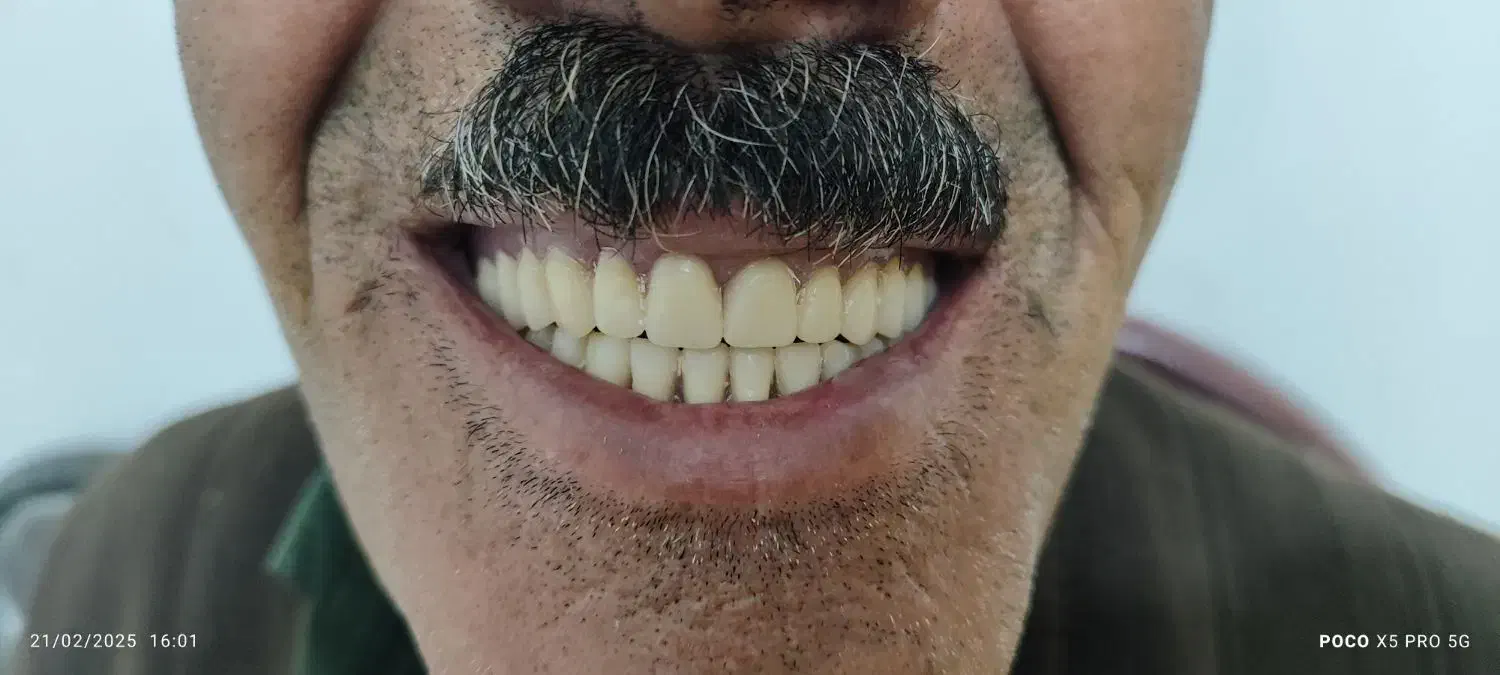 دندان مصنوعی|آرایشی، بهداشتی، درمانی|لردگان, |دیوار