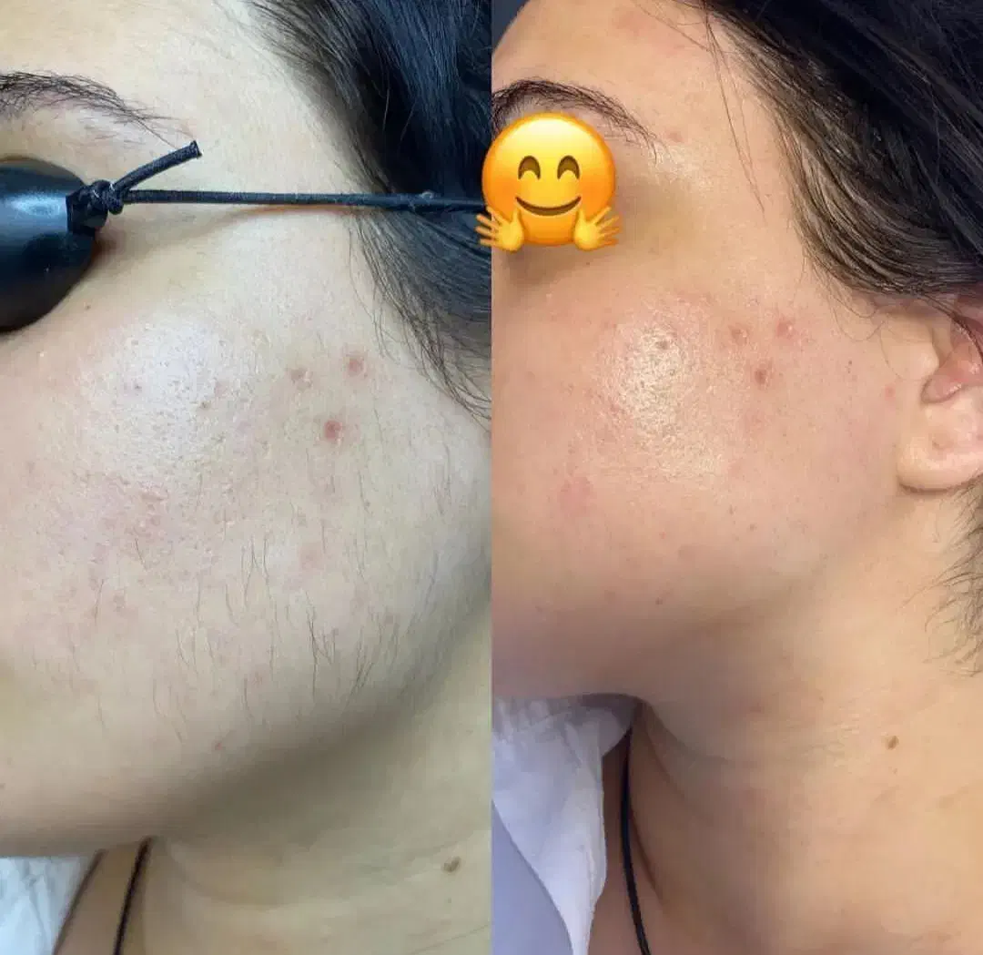 جدیدترین دستگاه لیزر 2025 در شهر جم|خدمات آرایشگری و زیبایی|جم, |دیوار