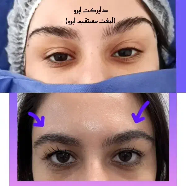 تخلیه وتزریق چربی لابیا جراحی پلک دایرکت اتوپلاستی|خدمات آرایشگری و زیبایی|دورود, |دیوار