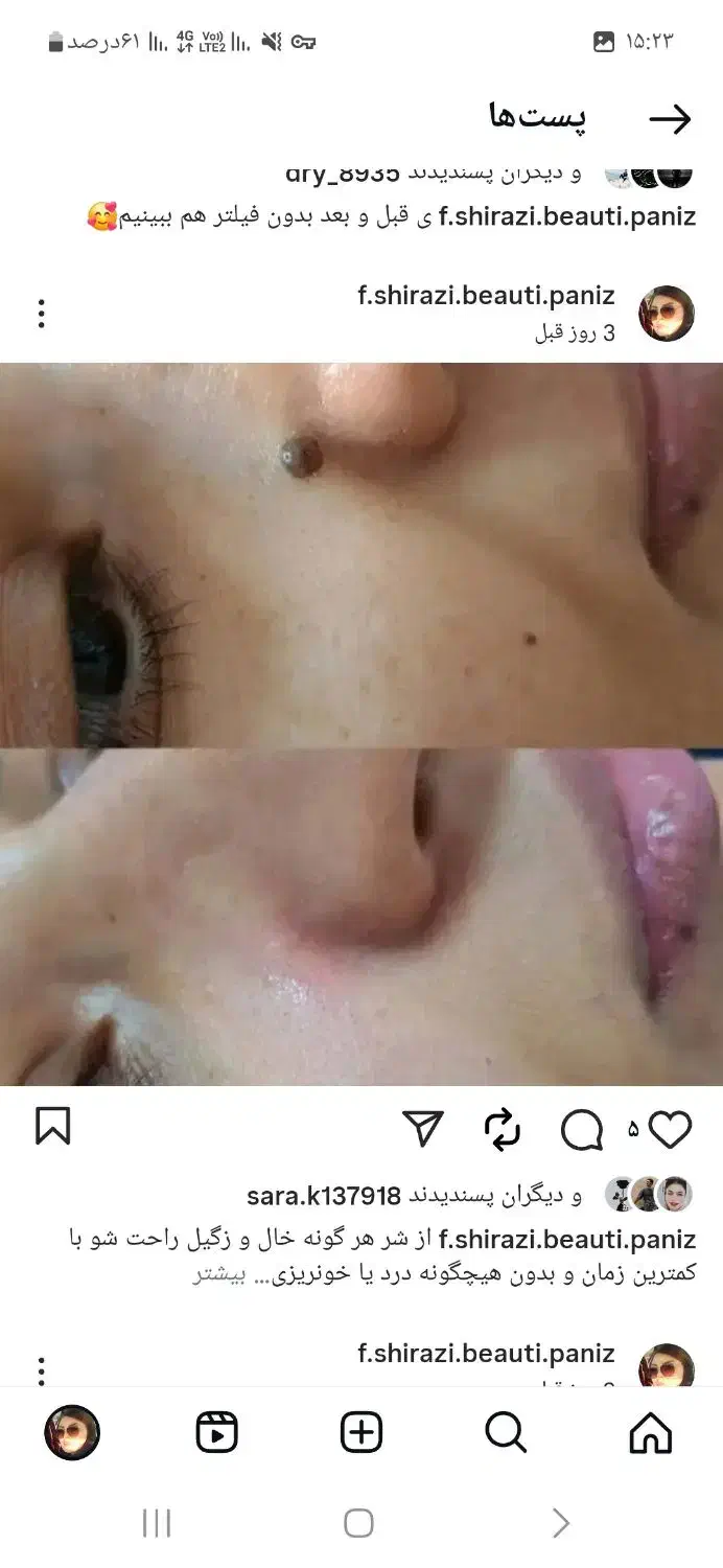 درمان کیست ملیا زیر چشم و برداشتن خال و زگیل|خدمات آرایشگری و زیبایی|نیشابور, دارایی|دیوار