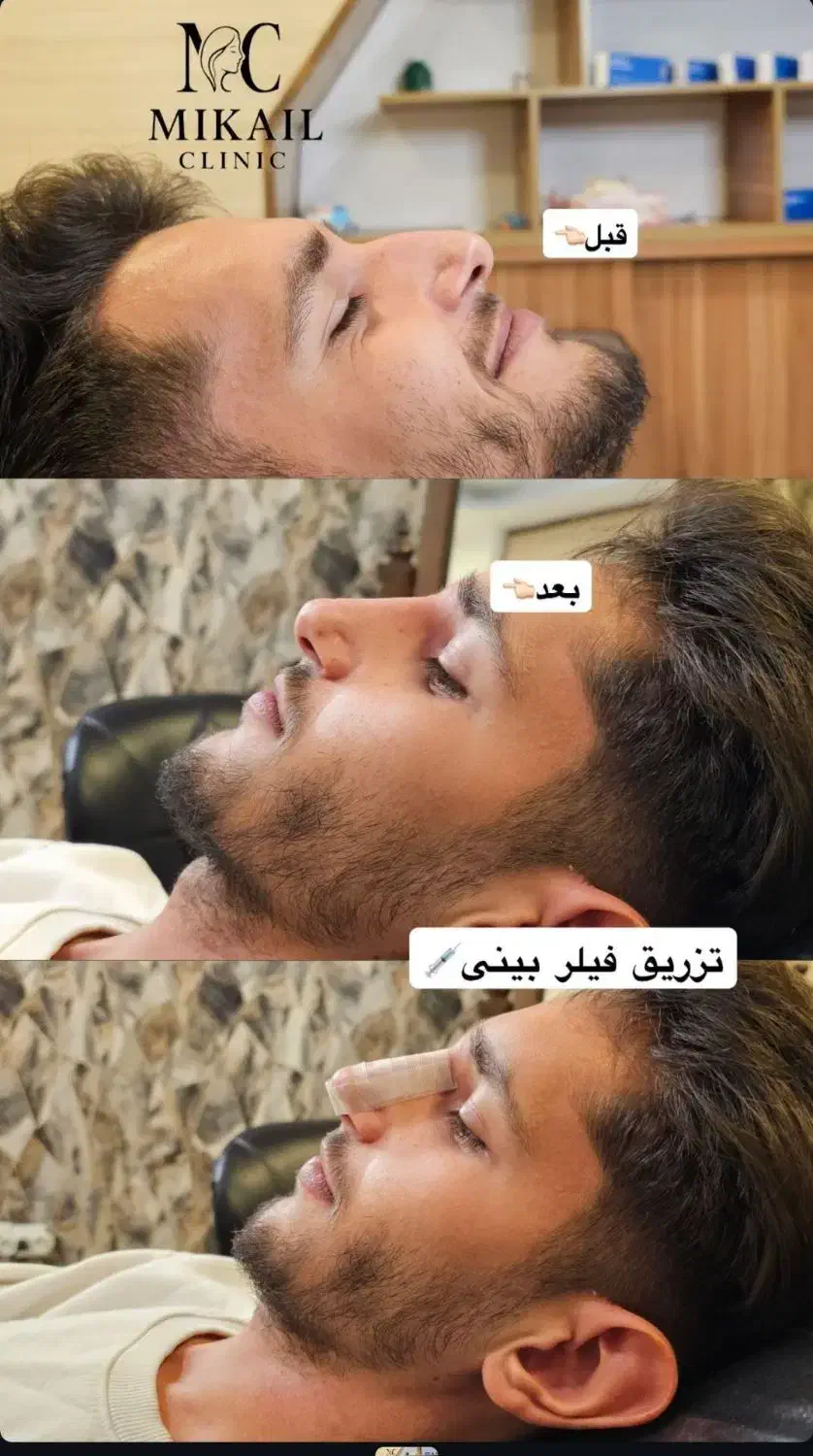 خدمات رایگان بوتاکس،ژل،فیلر توسط پزشک در ارومیه|خدمات آرایشگری و زیبایی|ارومیه, |دیوار