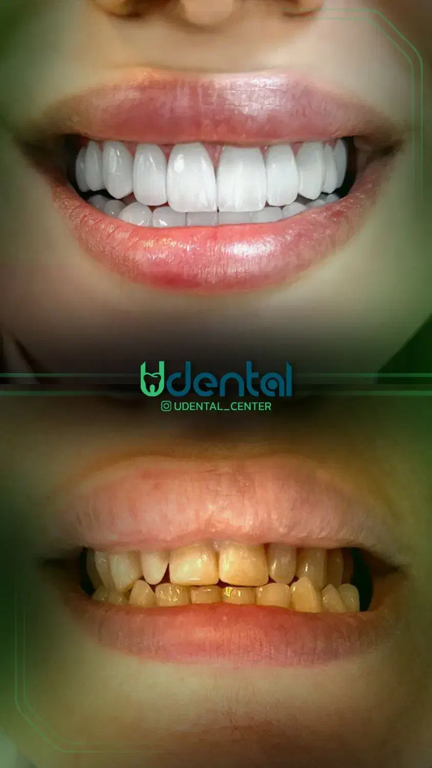 کامپوزیت، لمینت، ایمپلنت اقساط ویژه|خدمات آرایشگری و زیبایی|ری, شهرری|دیوار