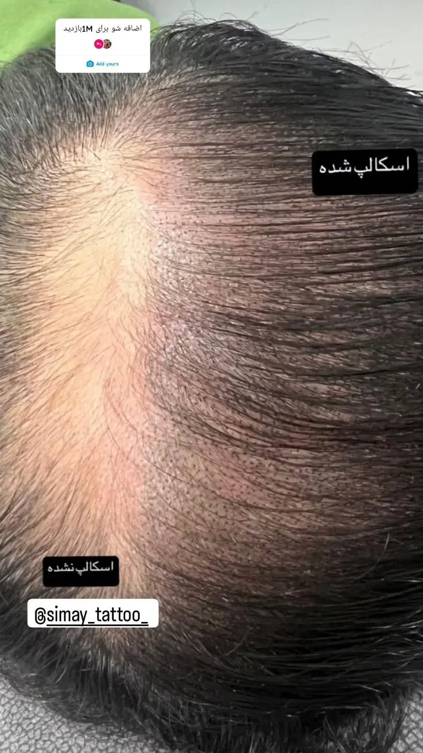 میکرو اسکالپ سر|خدمات آرایشگری و زیبایی|شیراز, اصلاح‌نژاد|دیوار