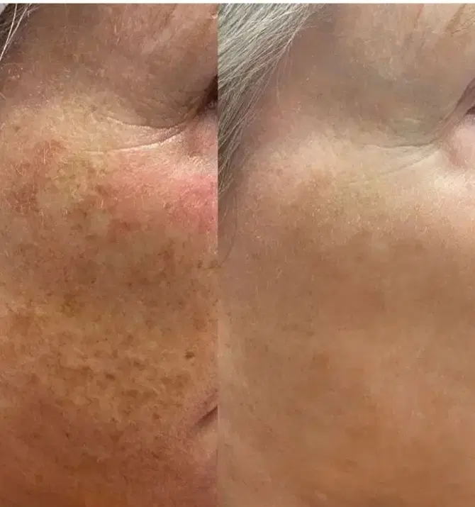 پاکسازی سوپرفشیال تخصصی، مطب ویژه آقایان وبانوان|خدمات زیبایی و سلامت|تهران, نارمک|دیوار