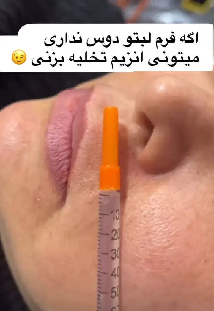 ژل و بوتاکس فقط سی سی 350|خدمات آرایشگری و زیبایی|تهران, مختاری|دیوار