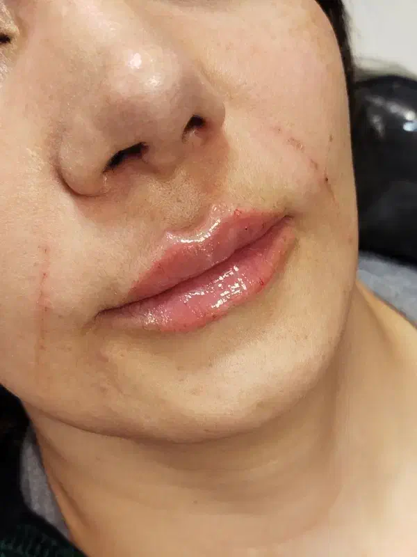 تزریق ژل / بوتاکس|خدمات آرایشگری و زیبایی|اردبیل, |دیوار