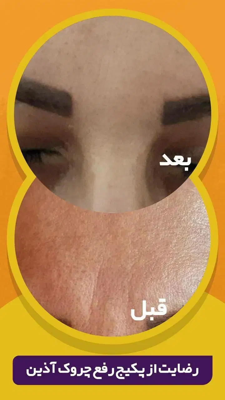 کرم بوتاکس حرفه ای آذین|آرایشی، بهداشتی، درمانی|شیراز, جانبازان|دیوار